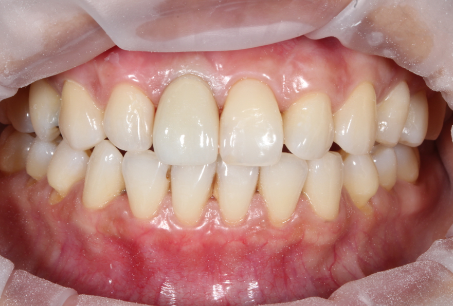 After treatment, showing the completed single implant crown