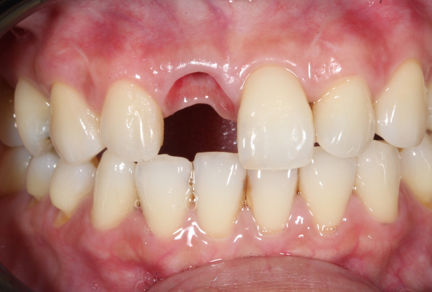 Before treatment, showing a missing upper front tooth