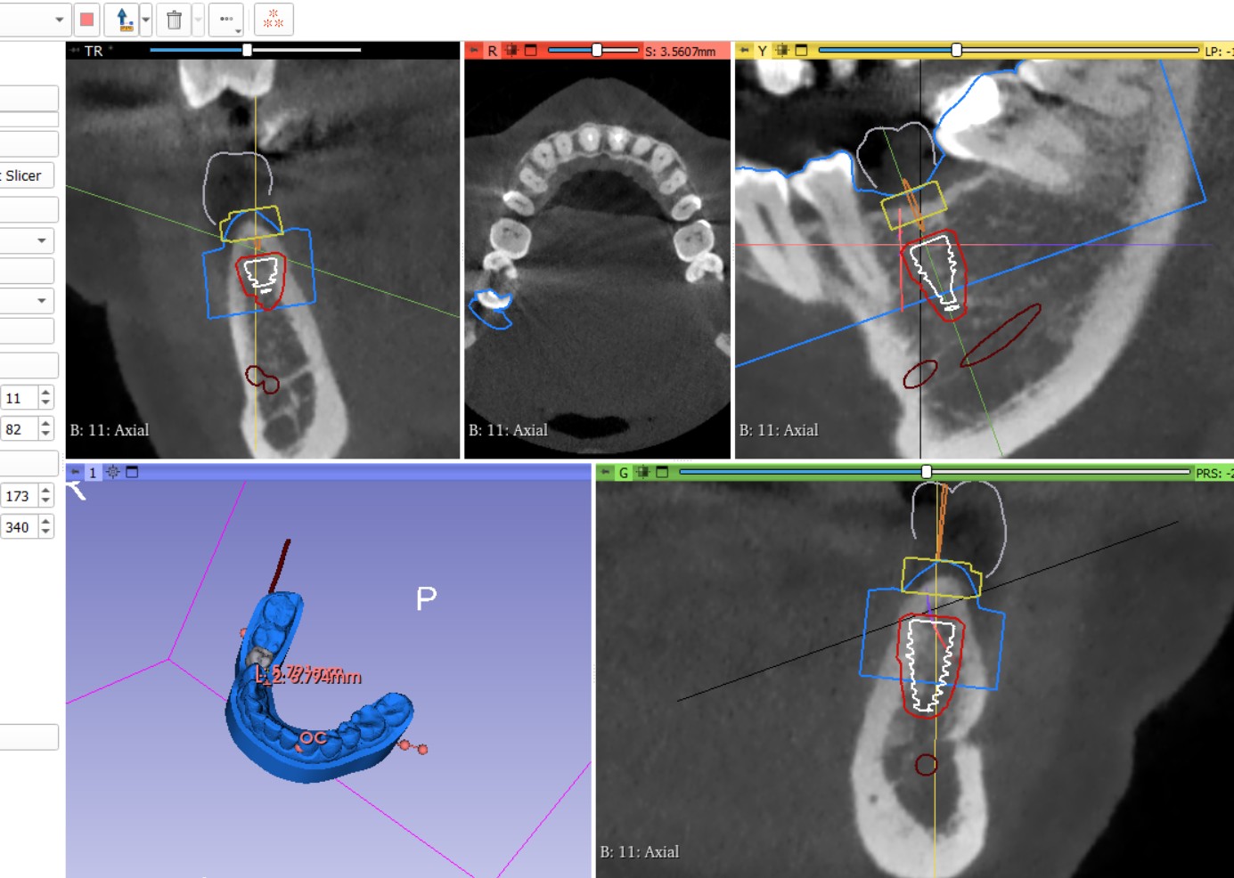 Digital 3D planning for a single dental implant