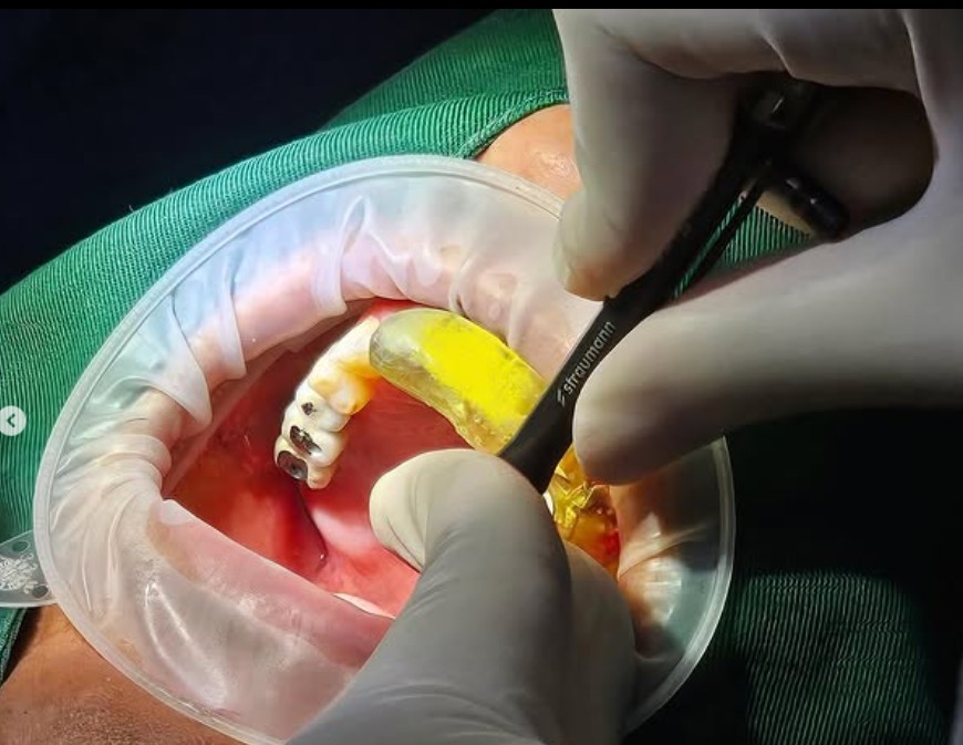 Custom surgical guide being used during implant placement