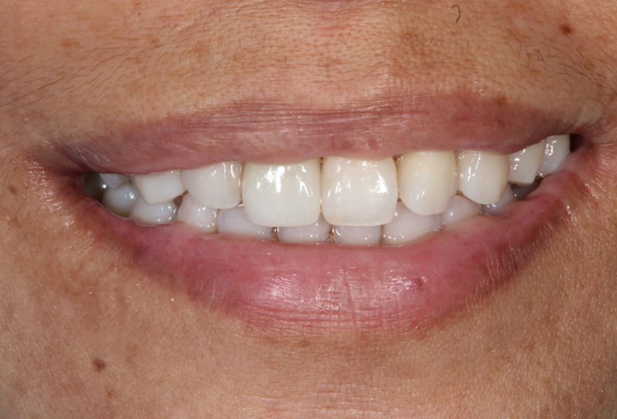 Patient smile after single implant treatment